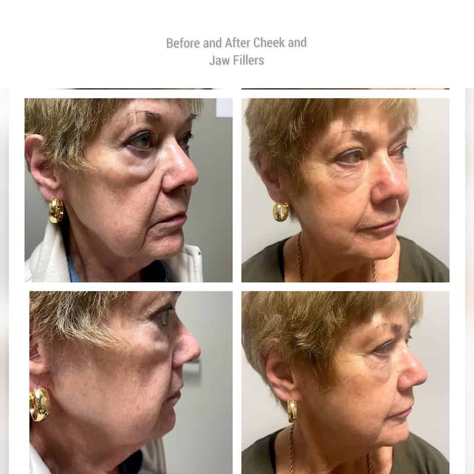 Cheek And Jaw Fillers Before And After Gallery | Idunn Clinic in Torrance, CA