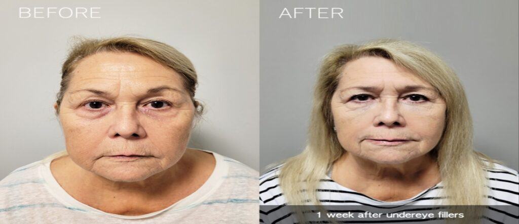 Fillers Before And After Gallery | Idunn Clinic in Torrance, CA