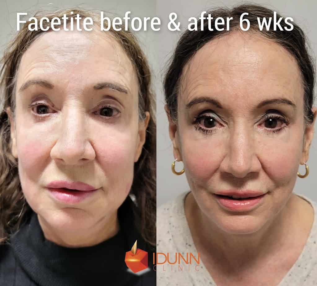 Facetite Before And After Gallery | Idunn Clinic in Torrance, CA
