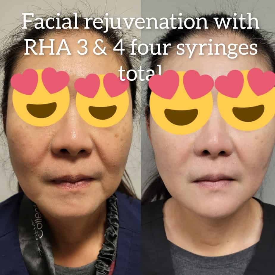 Facial Rejuvenation With RHA Three And Four Syrings Total Before And After Gallery | Idunn Clinic in Torrance, CA