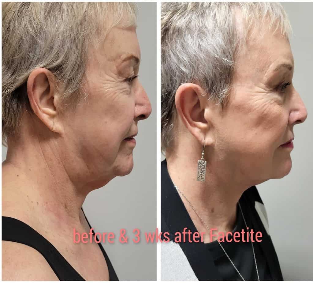 Facetite Three Weeks Before And After Gallery | Idunn Clinic in Torrance, CA