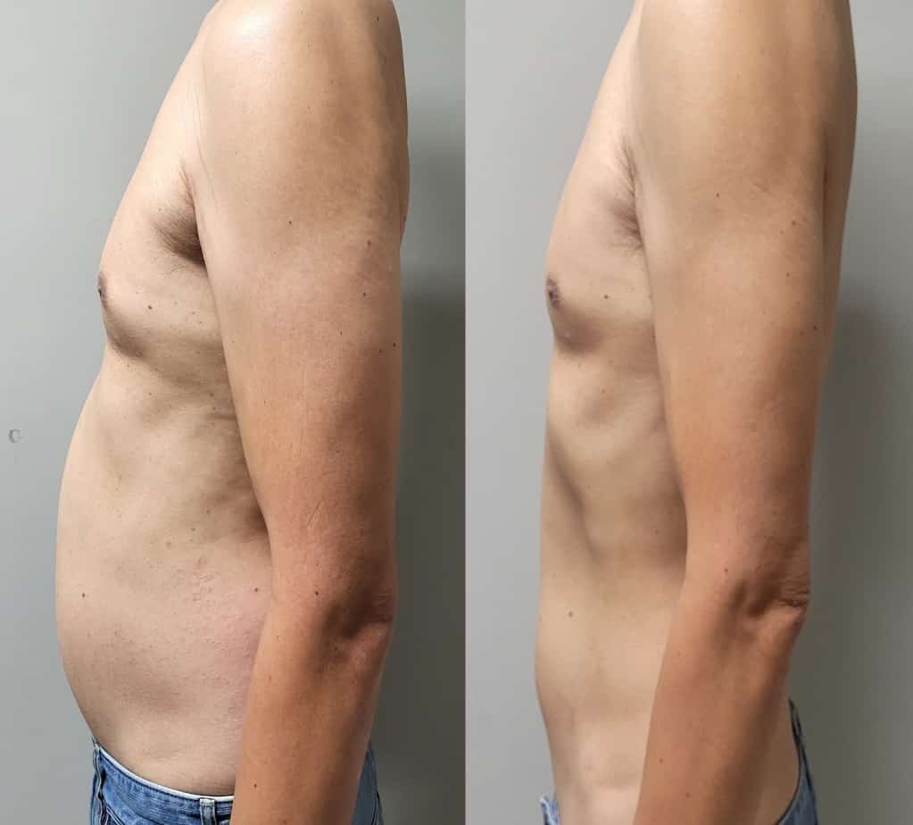 Stomach Before And After Gallery | Idunn Clinic in Torrance, CA