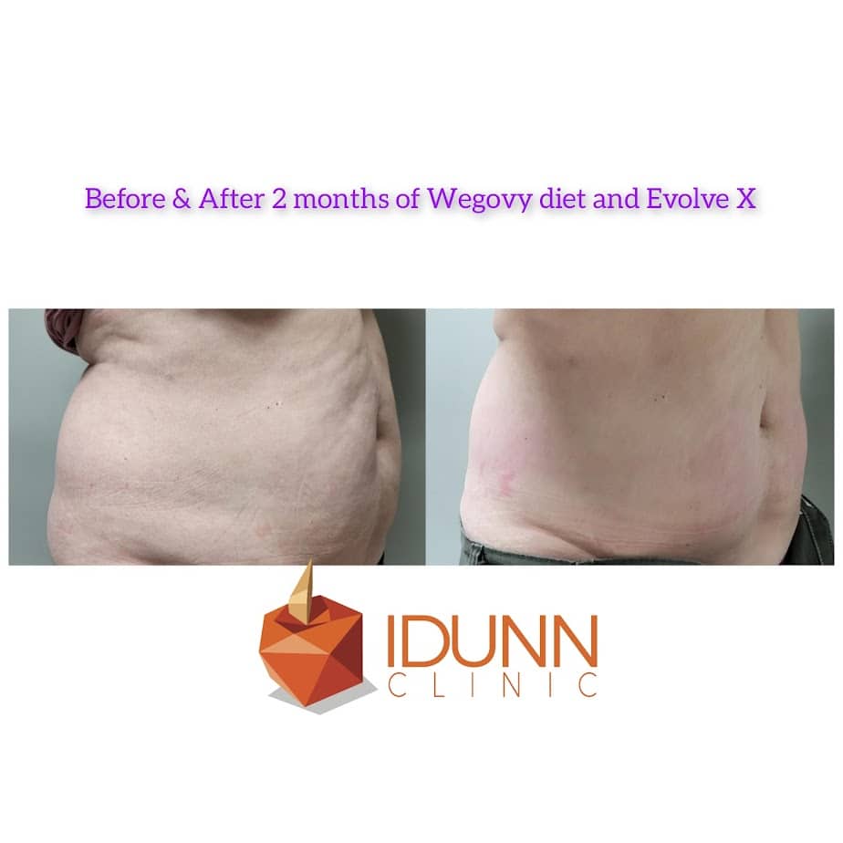 Wegovy Diet And Evolve X Two Months Before And After Gallery | Idunn Clinic in Torrance, CA