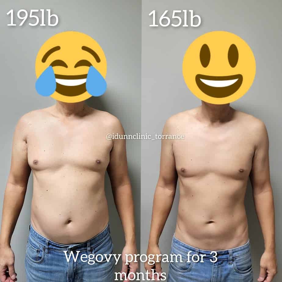 Wegovy Program For Three Months Before After Gallery | Idunn Clinic in Torrance, CA