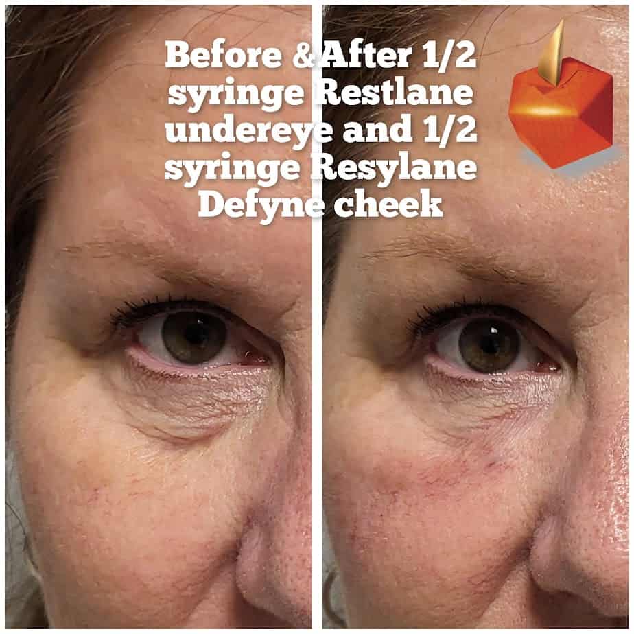 Syringe Restylane Undereye And Syringe Restylane Defyne Cheek Before And After Gallery | Idunn Clinic in Torrance, CA